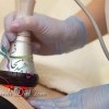 لاغری، فرم دهی و لیفت پوست با دستگاه RF