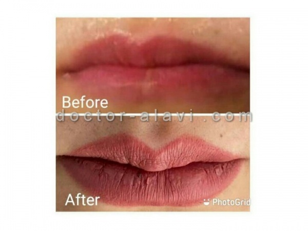هزینه تزریق ژل لب