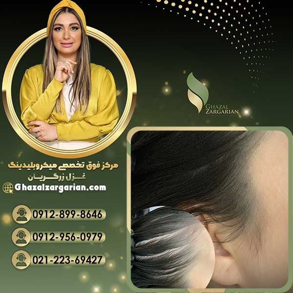 تاتو اسکالپ سر در تهران